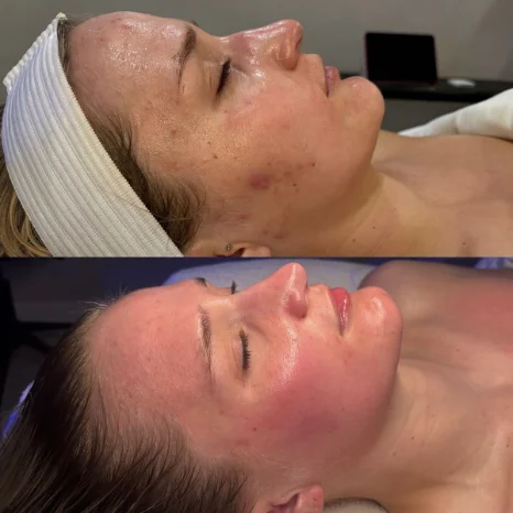 Skin before and after a treatment
