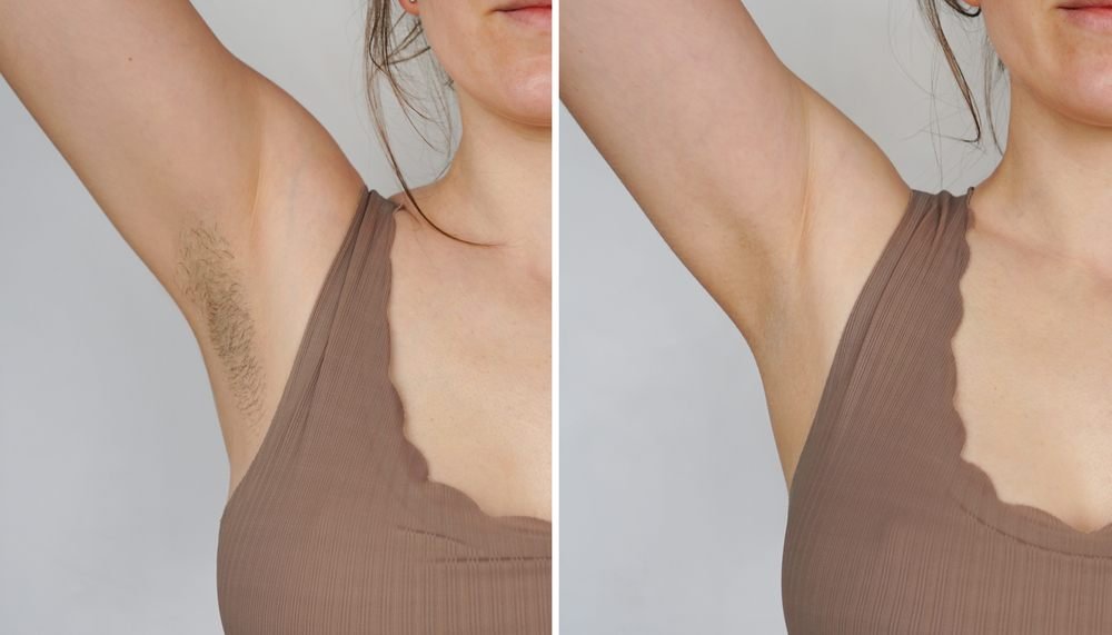 Laser hair removal — before and after