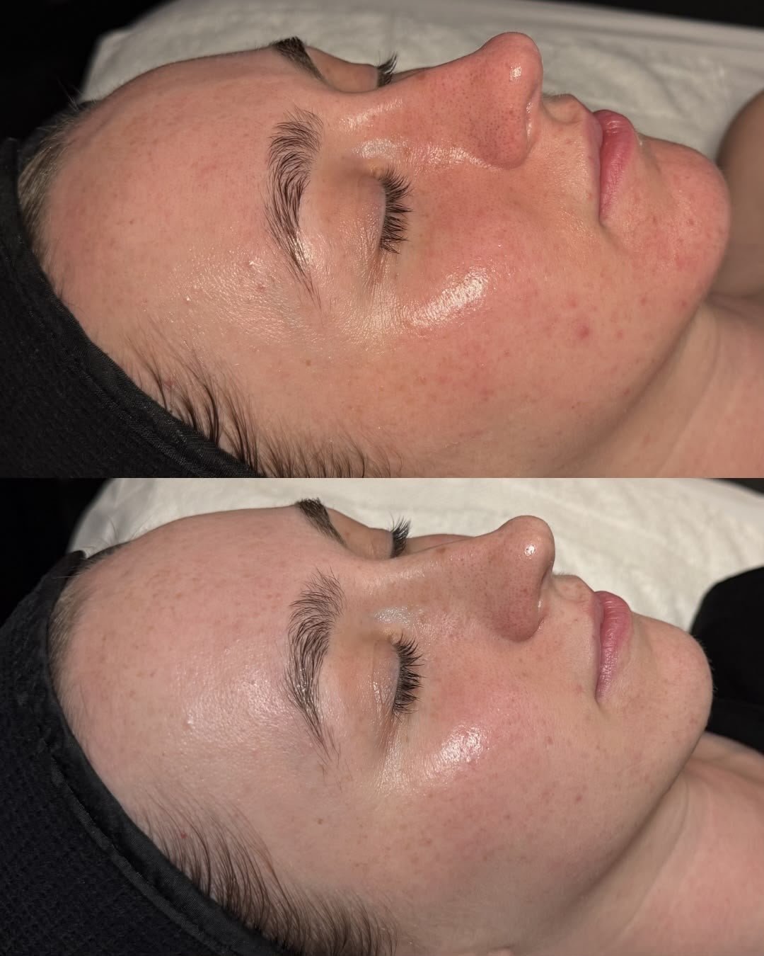 Microneedling — before (top) and after (bottom)