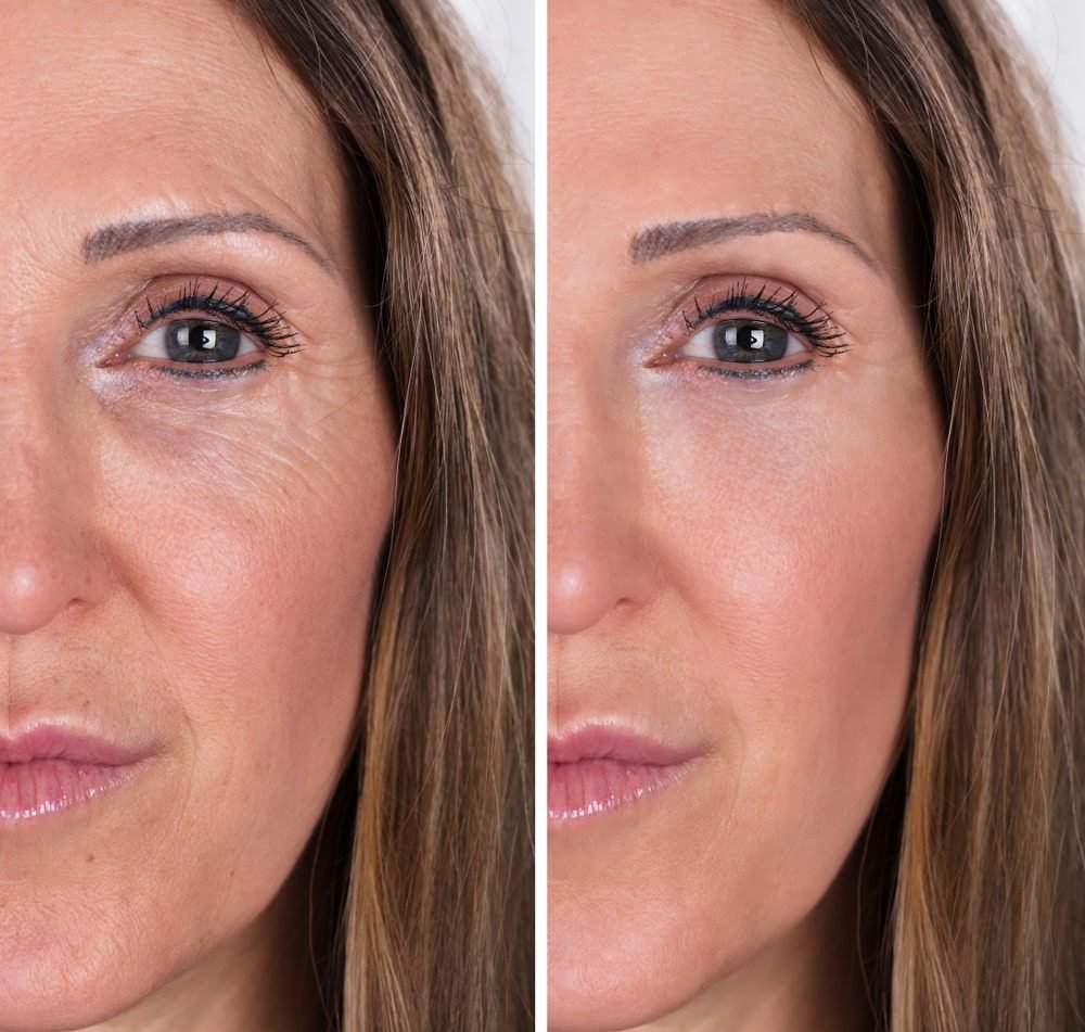 Photorejuvenation — before and after
