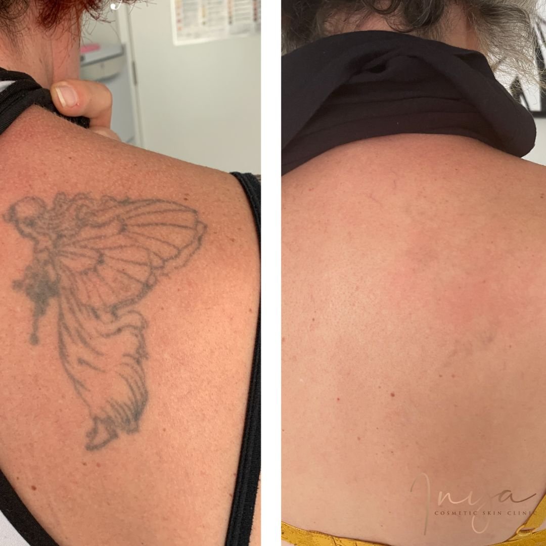 Tattoo removal — before and after