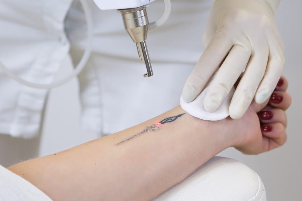 Laser tattoo removal treatment